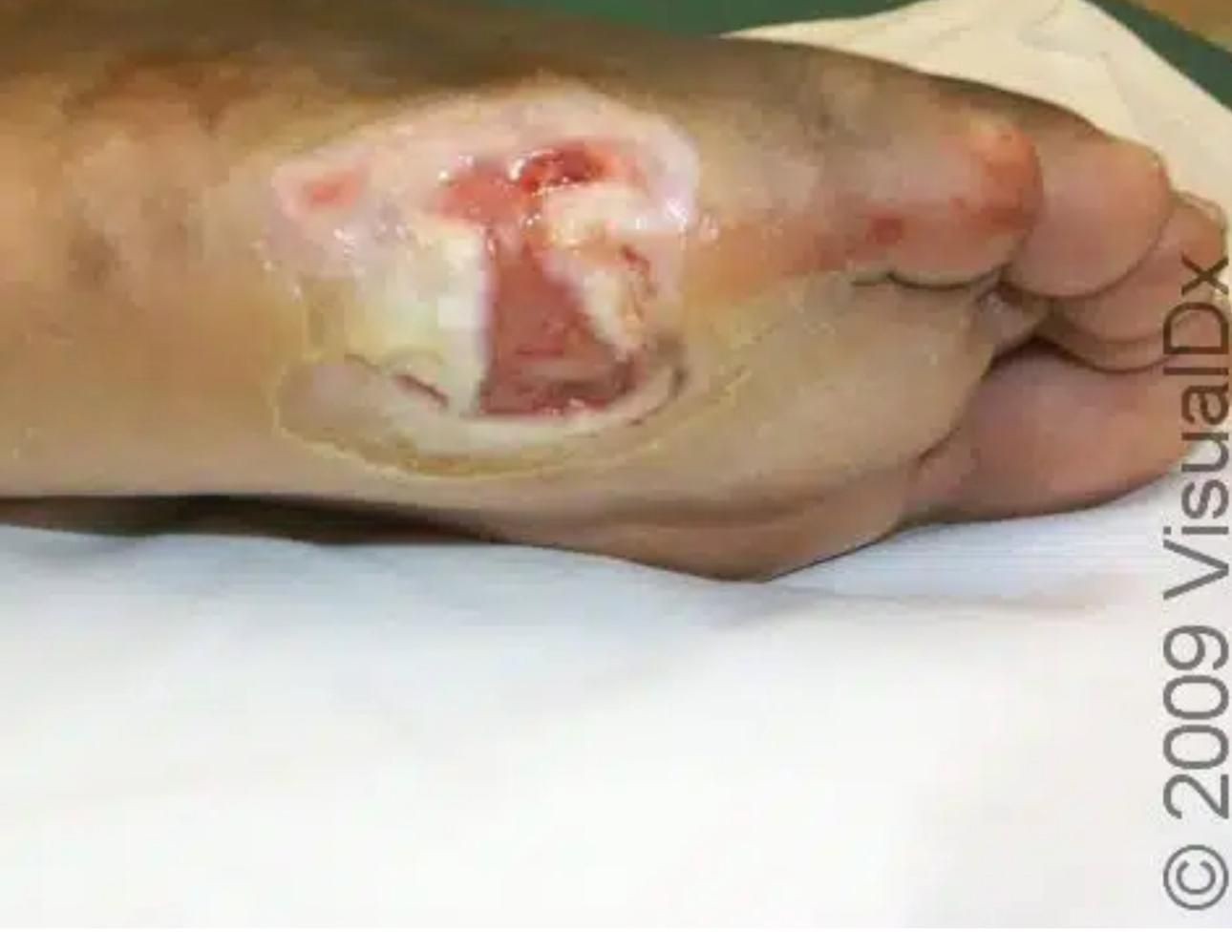 Tratamiento de Heridas Crónicas
